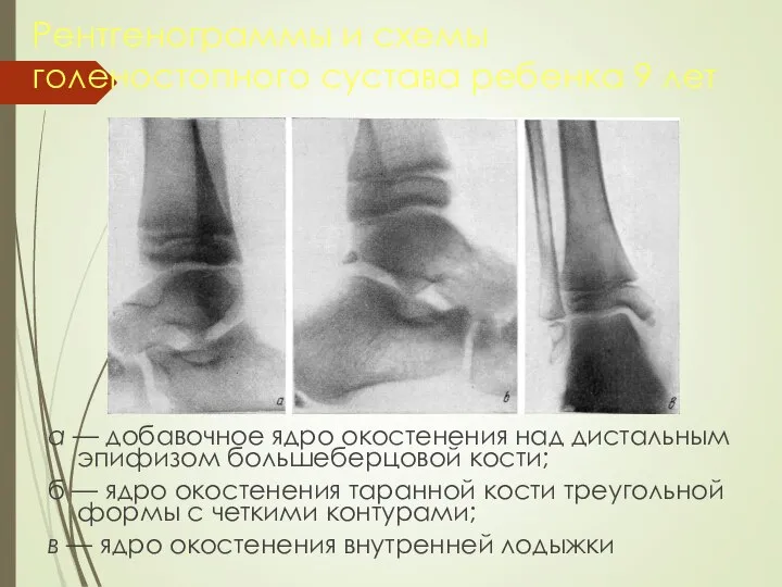 Рентгенограммы и схемы голеностопного сустава ребенка 9 лет а — добавочное ядро