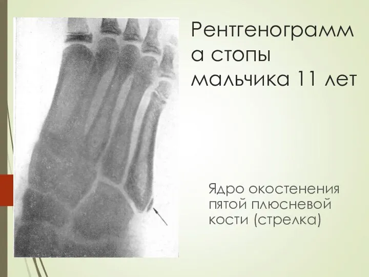 Рентгенограмма стопы мальчика 11 лет Ядро окостенения пятой плюсневой кости (стрелка)