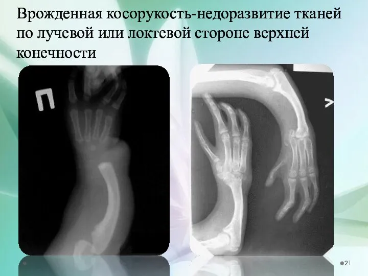 Врожденная косорукость-недоразвитие тканей по лучевой или локтевой стороне верхней конечности