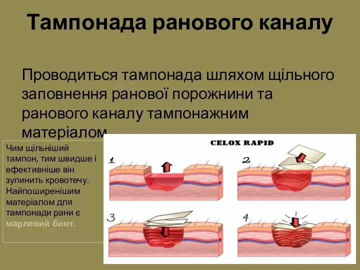 Тампонада ранового каналу Проводиться тампонада шляхом щільного заповнення ранової порожнини та ранового