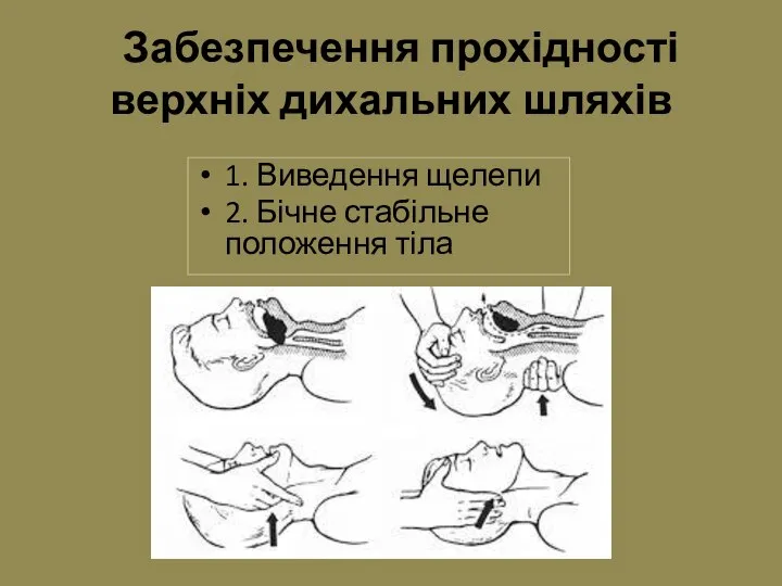 Забезпечення прохідності верхніх дихальних шляхів 1. Виведення щелепи 2. Бічне стабільне положення тіла