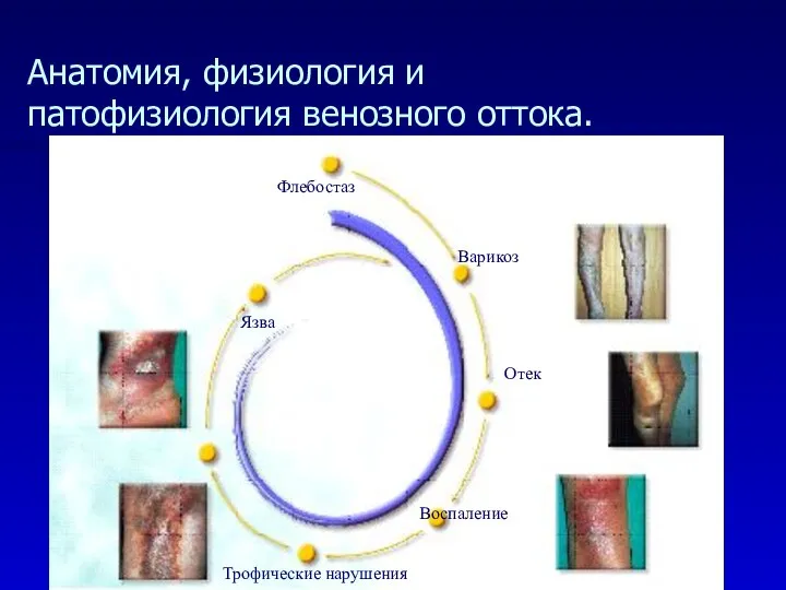 Анатомия, физиология и патофизиология венозного оттока. Флебостаз Варикоз Отек Воспаление Трофические нарушения Язва