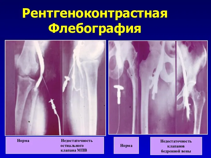 Рентгеноконтрастная Флебография Норма Недостаточность остиального клапана МПВ Норма Недостаточность клапанов бедренной вены