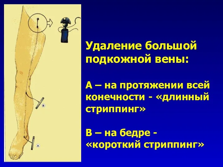 Удаление большой подкожной вены: А – на протяжении всей конечности - «длинный