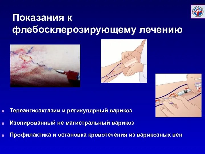 Показания к флебосклерозирующему лечению Телеангиоэктазии и ретикулярный варикоз Изолированный не магистральный варикоз