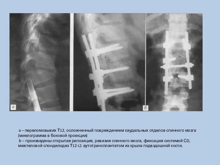 a – переломовывих Т12, осложненный повреждением каудальных отделов спинного мозга (миелограмма в