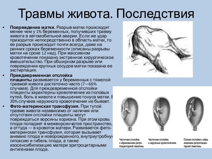 Травмы живота. Последствия Повреждение матки. Разрыв матки происходит менее чем у 1%