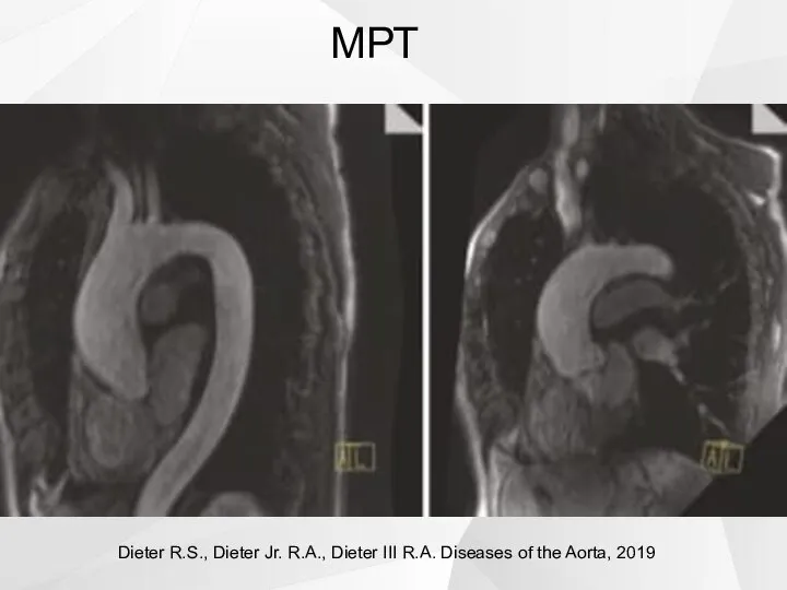 МРТ Dieter R.S., Dieter Jr. R.A., Dieter III R.A. Diseases of the Aorta, 2019