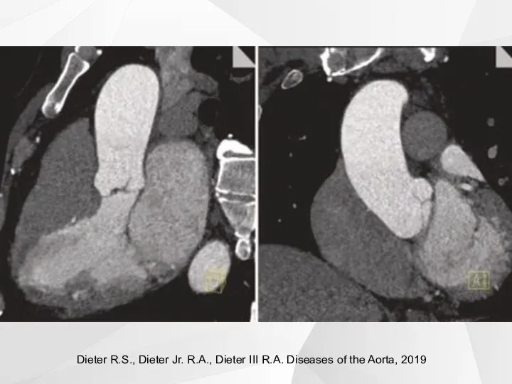 Dieter R.S., Dieter Jr. R.A., Dieter III R.A. Diseases of the Aorta, 2019