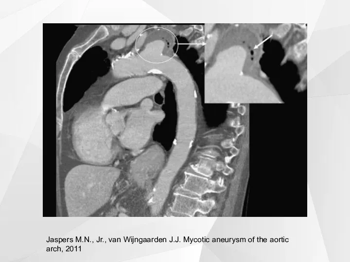 Jaspers M.N., Jr., van Wijngaarden J.J. Mycotic aneurysm of the aortic arch, 2011