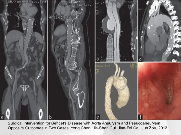 Surgical Intervention for Behcet's Disease with Aorta Aneurysm and Pseudoaneurysm: Opposite Outcomes