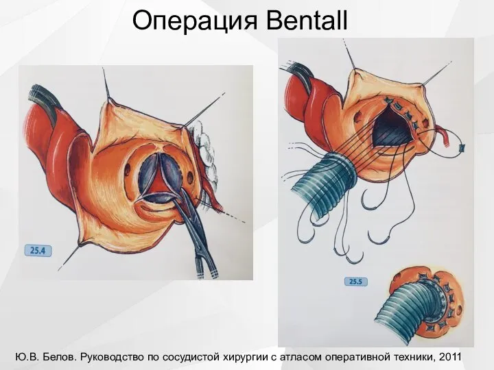 Операция Bentall Ю.В. Белов. Руководство по сосудистой хирургии с атласом оперативной техники, 2011