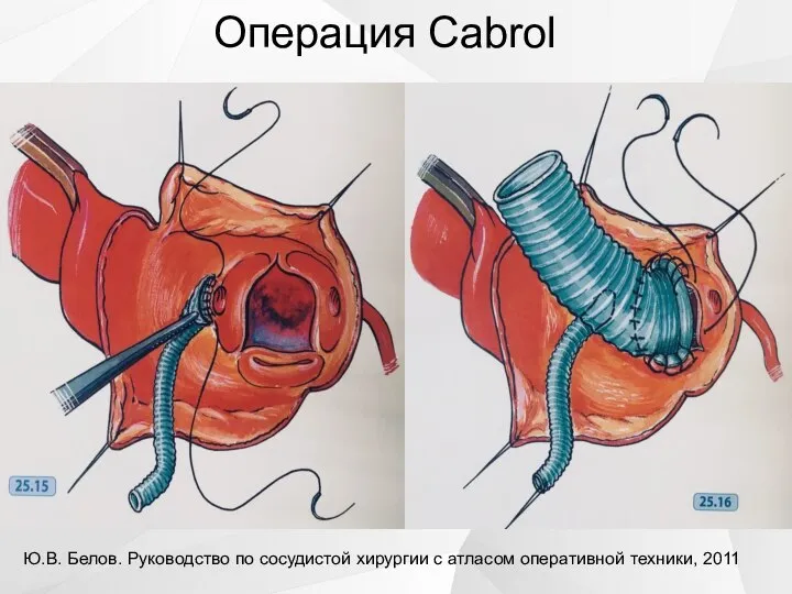 Операция Cabrol Ю.В. Белов. Руководство по сосудистой хирургии с атласом оперативной техники, 2011