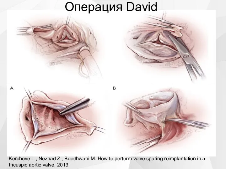 Kerchove L., Nezhad Z., Boodhwani M. How to perform valve sparing reimplantation