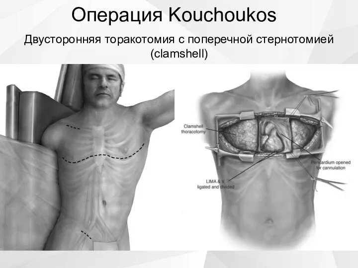 Операция Kouchoukos Двусторонняя торакотомия с поперечной стернотомией (clamshell)