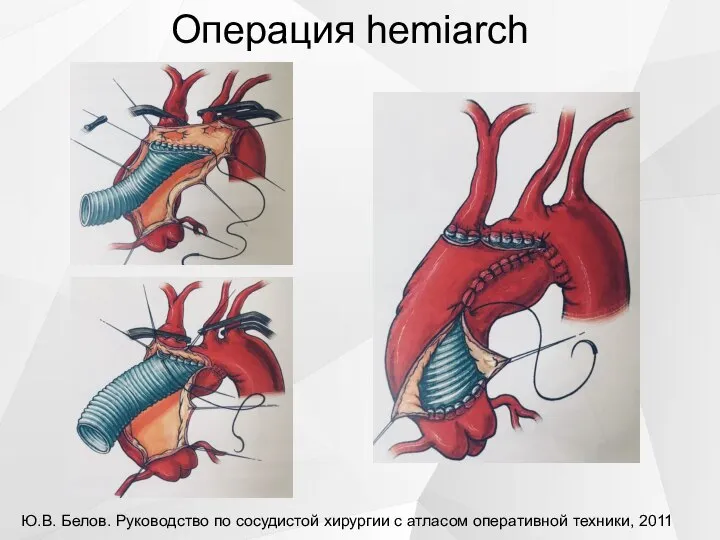 Операция hemiarch Ю.В. Белов. Руководство по сосудистой хирургии с атласом оперативной техники, 2011