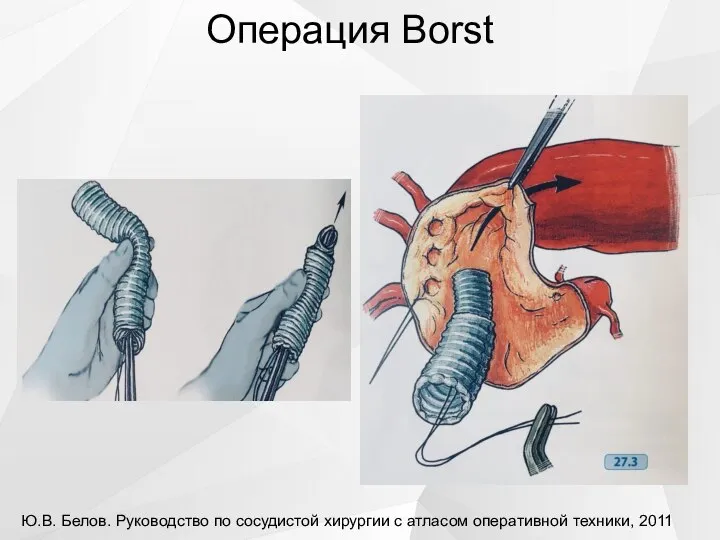 Операция Borst Ю.В. Белов. Руководство по сосудистой хирургии с атласом оперативной техники, 2011