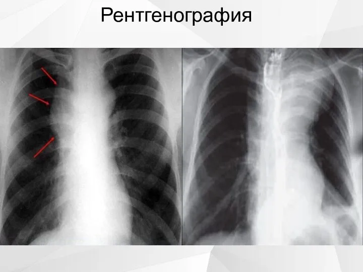 Рентгенография