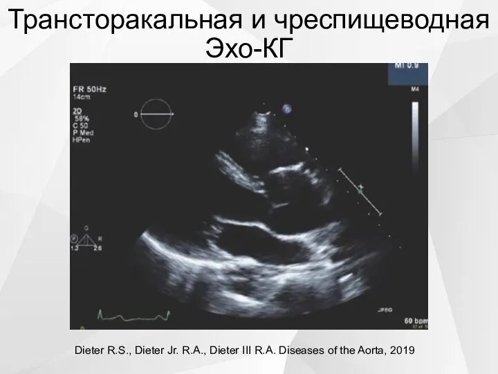 Трансторакальная и чреспищеводная Эхо-КГ Dieter R.S., Dieter Jr. R.A., Dieter III R.A.