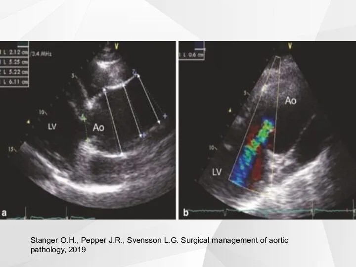 Stanger O.H., Pepper J.R., Svensson L.G. Surgical management of aortic pathology, 2019