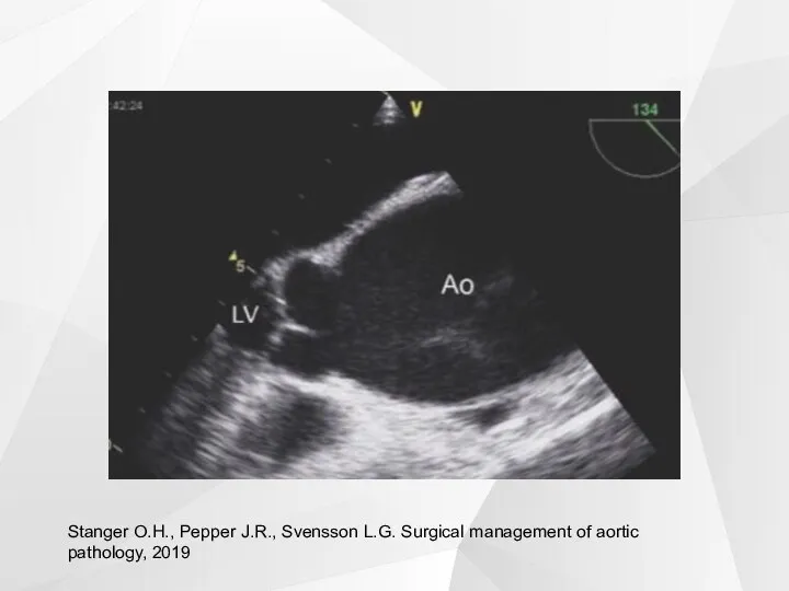Stanger O.H., Pepper J.R., Svensson L.G. Surgical management of aortic pathology, 2019