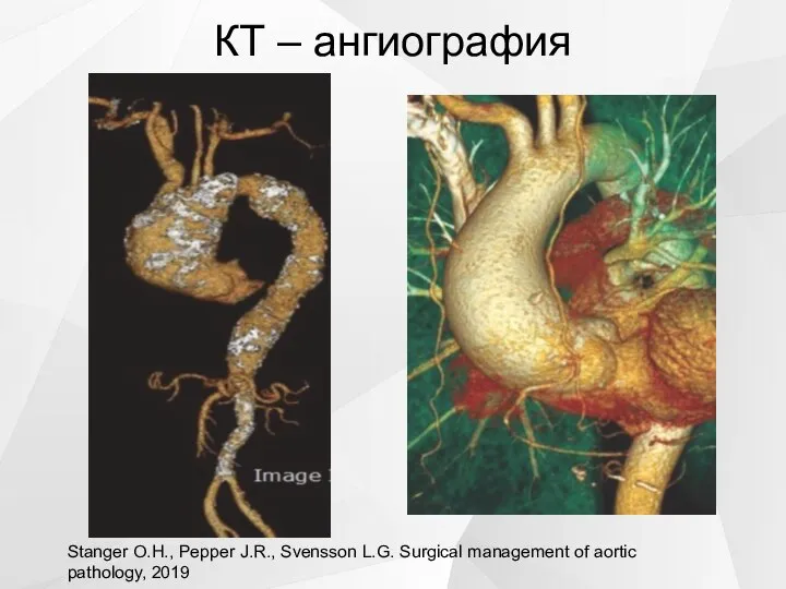 КТ – ангиография Stanger O.H., Pepper J.R., Svensson L.G. Surgical management of aortic pathology, 2019