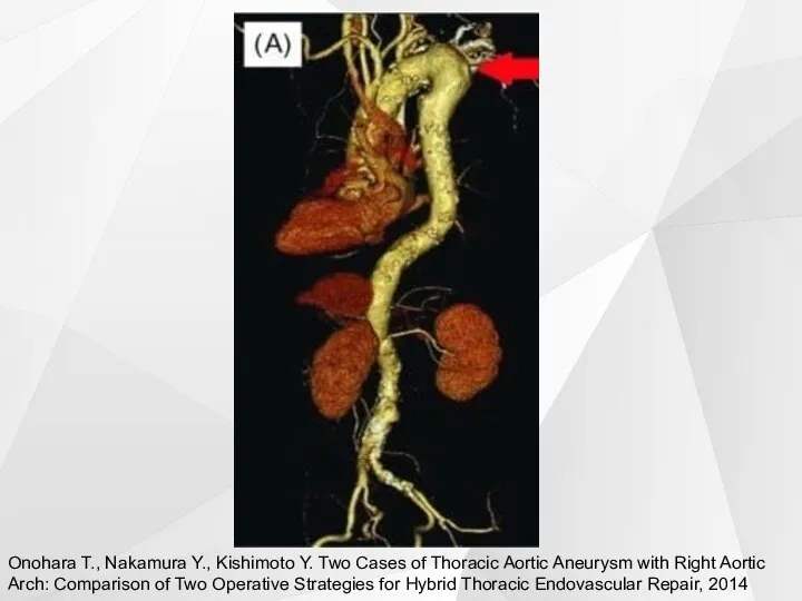 Onohara T., Nakamura Y., Kishimoto Y. Two Cases of Thoracic Aortic Aneurysm