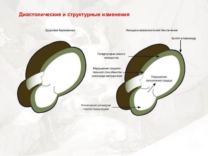 Диастолические и структурные изменения