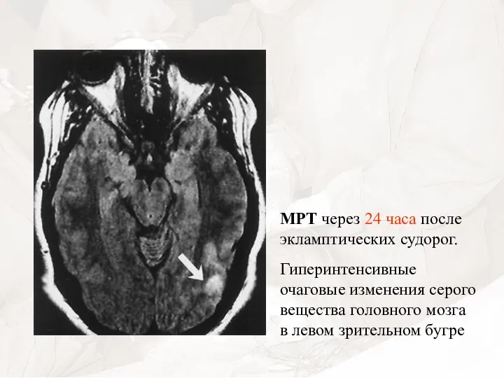 МРТ через 24 часа после экламптических судорог. Гиперинтенсивные очаговые изменения серого вещества