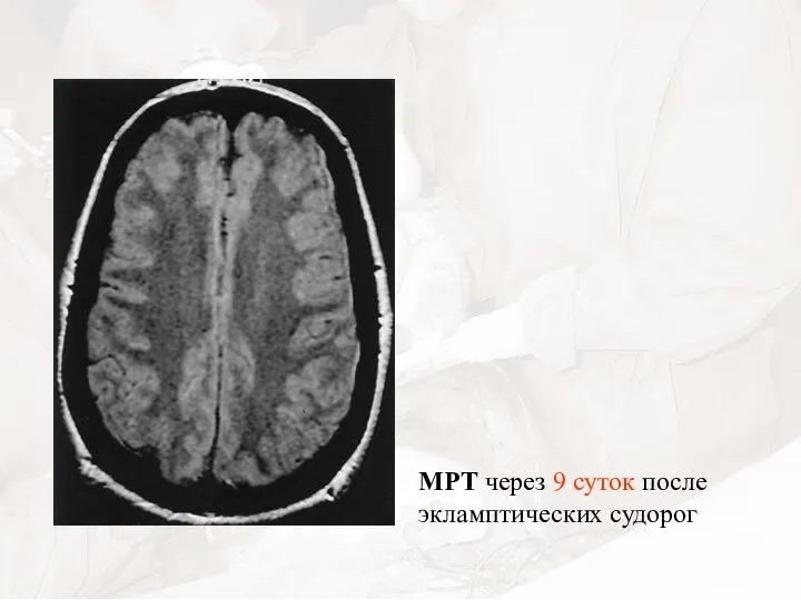 МРТ через 9 суток после экламптических судорог