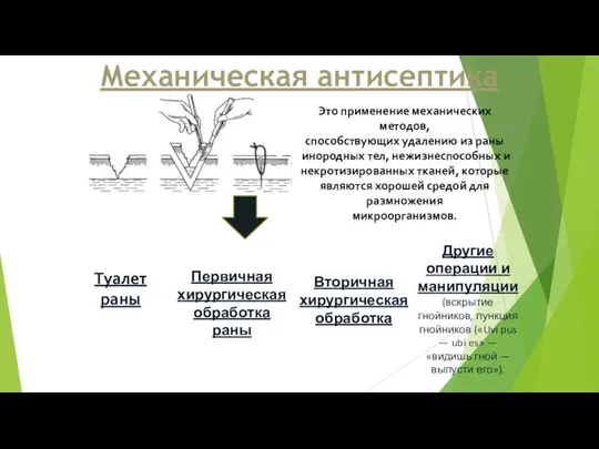 Механическая антисептика Это применение механических методов, способствующих удалению из раны инородных тел,