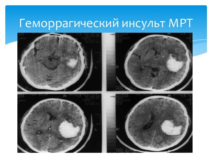 Геморрагический инсульт МРТ