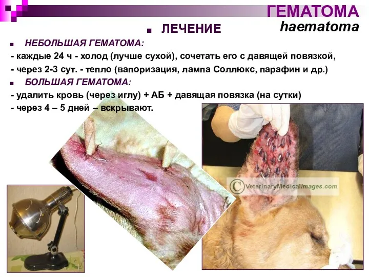 ГЕМАТОМА haematoma ЛЕЧЕНИЕ НЕБОЛЬШАЯ ГЕМАТОМА: - каждые 24 ч - холод (лучше