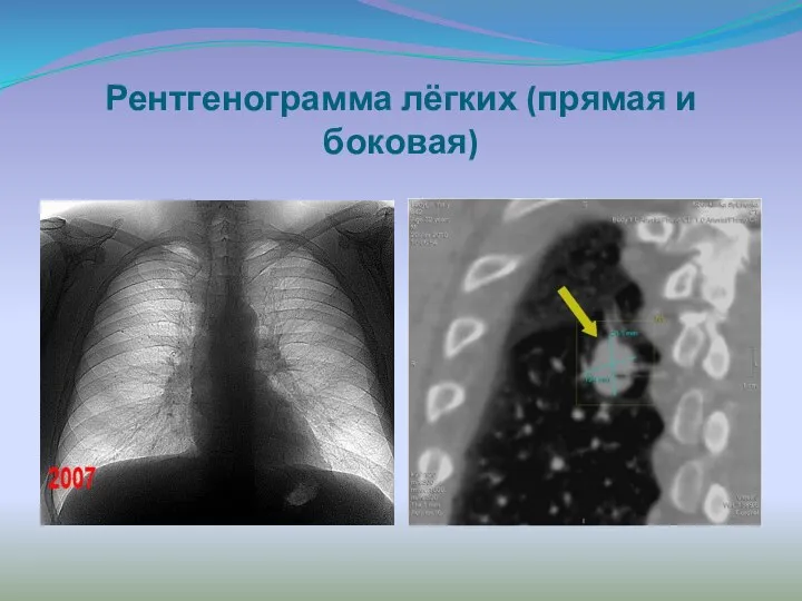 Рентгенограмма лёгких (прямая и боковая)