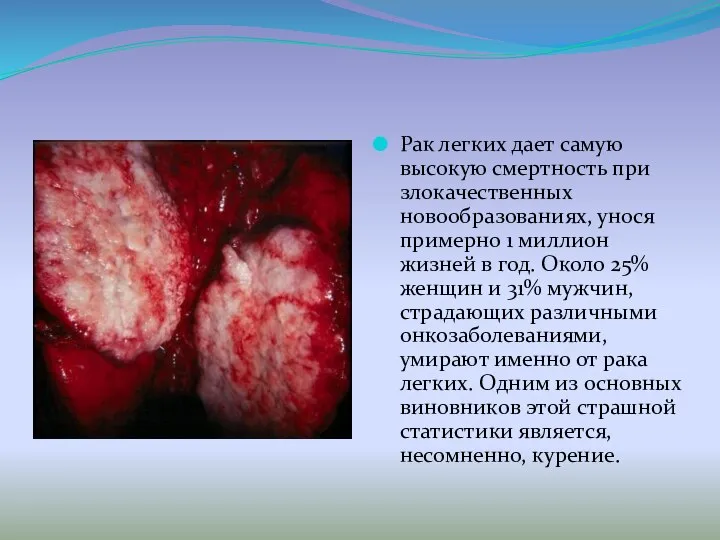 Рак легких дает самую высокую смертность при злокачественных новообразованиях, унося примерно 1