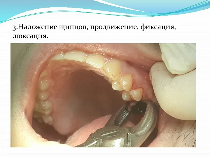 3.Наложение щипцов, продвижение, фиксация, люксация.