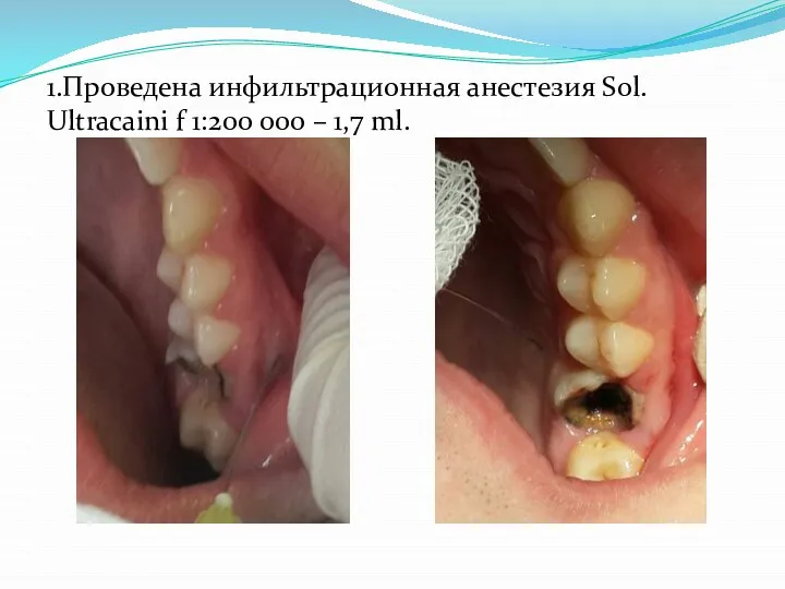 1.Проведена инфильтрационная анестезия Sol. Ultracaini f 1:200 000 – 1,7 ml.