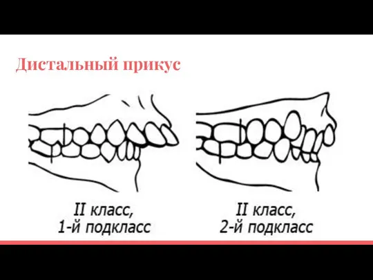 Дистальный прикус