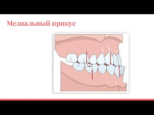 Мезиальный прикус