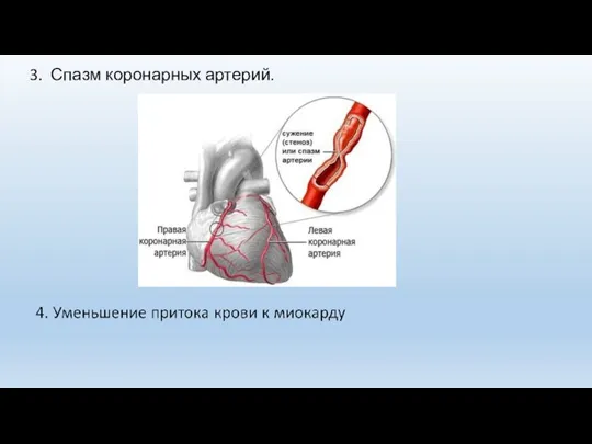 3. Спазм коронарных артерий.