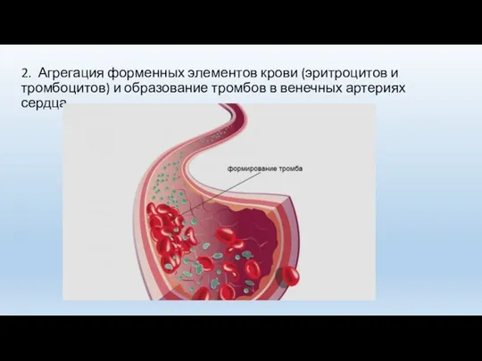 2. Агрегация форменных элементов крови (эритроцитов и тромбоцитов) и образование тромбов в венечных артериях сердца.