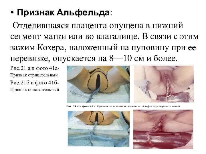 Признак Альфельда: Отделившаяся плацента опущена в нижний сегмент матки или во влагалище.