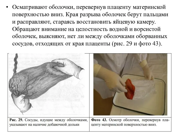 Осматривают оболочки, перевернув плаценту материнской поверхностью вниз. Края разрыва оболочек берут пальцами