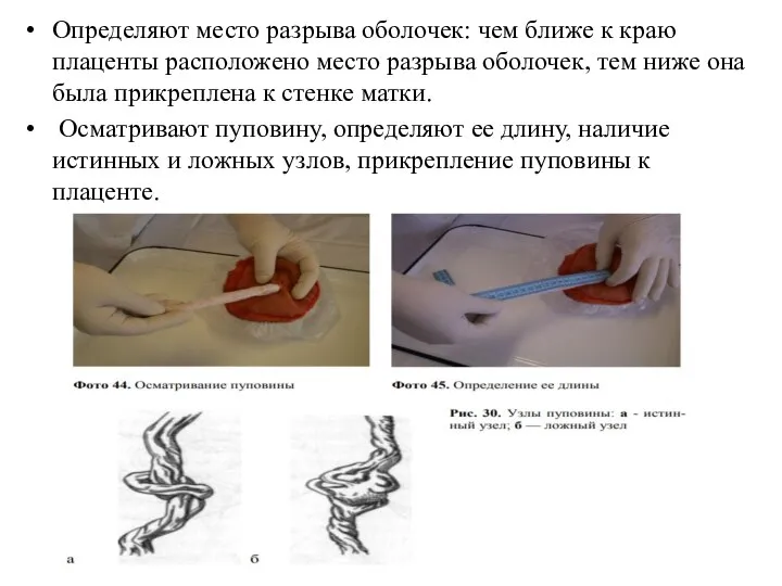 Определяют место разрыва оболочек: чем ближе к краю плаценты расположено место разрыва
