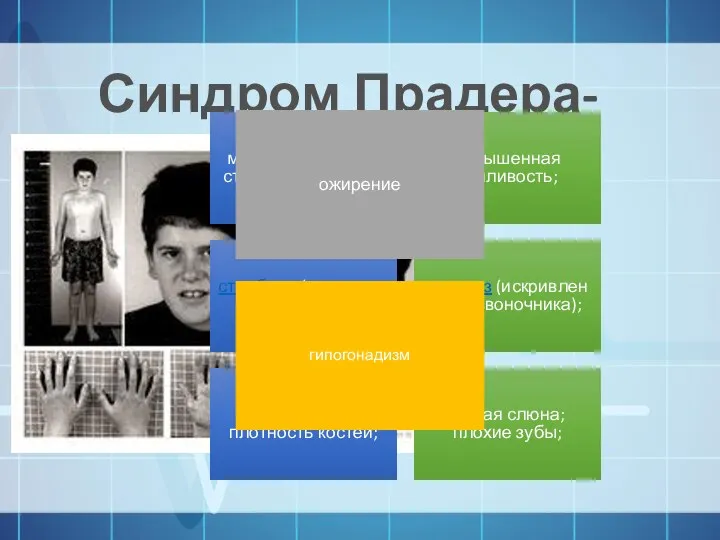 Синдром Прадера-Вилли маленькие кисти и стопы, низкий рост; повышенная сонливость; страбизм (косоглазие);