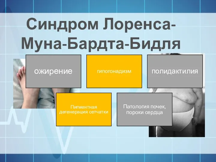 Синдром Лоренса-Муна-Бардта-Бидля ожирение гипогонадизм полидактилия Пигментная дегенерация сетчатки Патология почек,пороки сердца