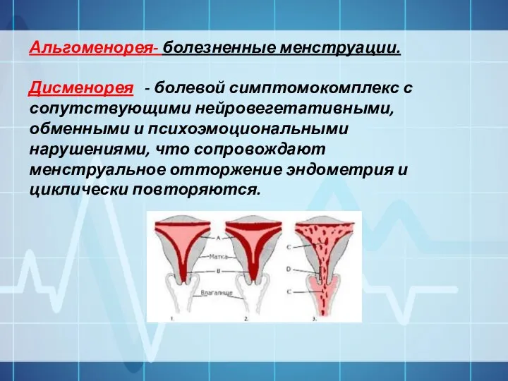 Альгоменорея- болезненные менструации. Дисменорея - болевой симптомокомплекс с сопутствующими нейровегетативными, обменными и