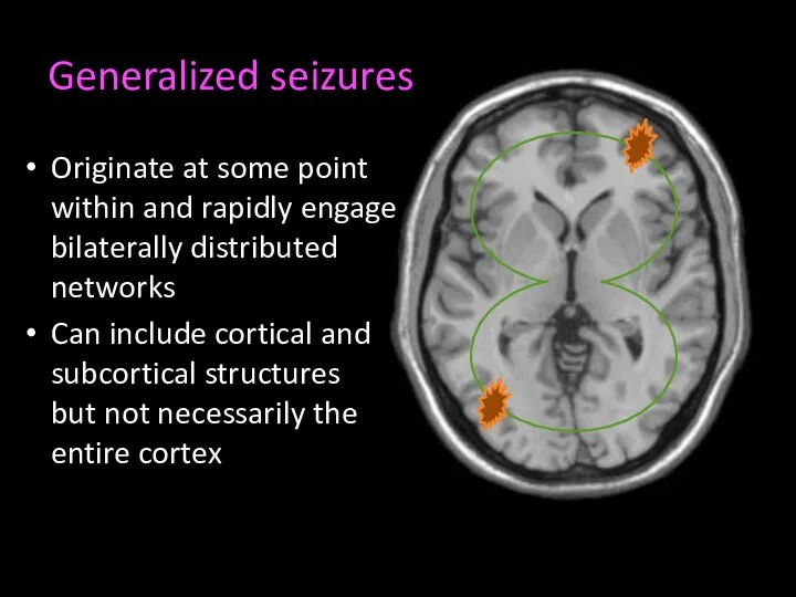 Generalized seizures Originate at some point within and rapidly engage bilaterally distributed