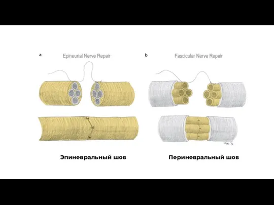 Эпиневральный шов Периневральный шов