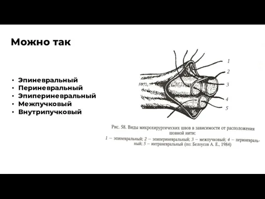 Эпиневральный Периневральный Эпипериневральный Межпучковый Внутрипучковый Можно так